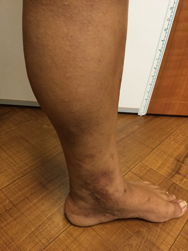 Vein Surgery Patient - Before and After, Atlanta Vein Specialists