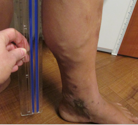 Vein Surgery Patient - Before and After, Atlanta Vein Specialists