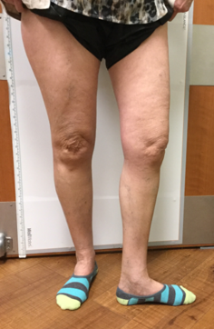 Vein Surgery Patient - Before and After, Atlanta Vein Specialists