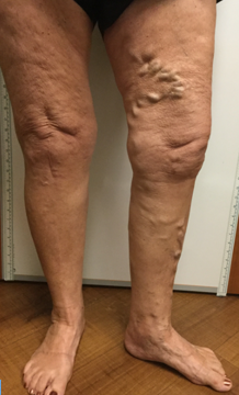 Vein Surgery Patient - Before and After, Atlanta Vein Specialists