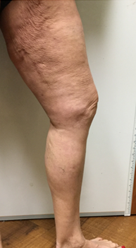 Vein Surgery Patient - Before and After, Atlanta Vein Specialists