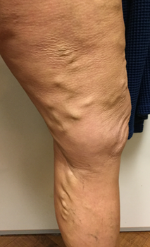 Vein Surgery Patient - Before and After, Atlanta Vein Specialists