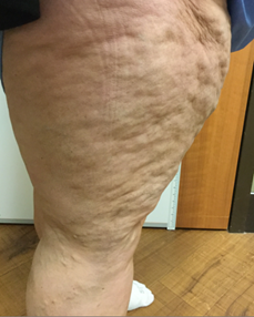 Vein Surgery Patient - Before and After, Atlanta Vein Specialists