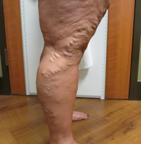 Vein Surgery Patient - Before and After, Atlanta Vein Specialists