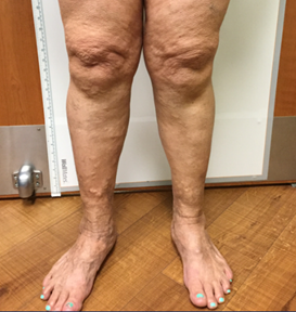 Vein Surgery Patient - Before and After, Atlanta Vein Specialists