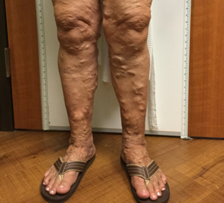 Vein Surgery Patient - Before and After, Atlanta Vein Specialists