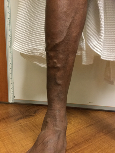 Vein Surgery Patient - Before and After, Atlanta Vein Specialists