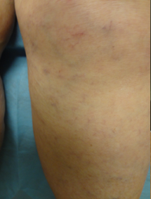 Vein Surgery Patient - Before and After, Atlanta Vein Specialists