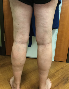 Vein Surgery Patient - Before and After, Atlanta Vein Specialists