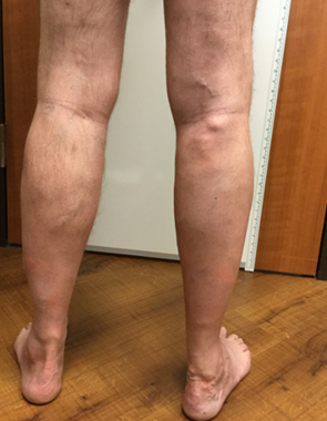 Vein Surgery Patient - Before and After, Atlanta Vein Specialists