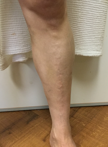 Vein Surgery Patient - Before and After, Atlanta Vein Specialists