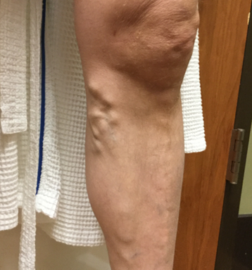 Vein Surgery Patient - Before and After, Atlanta Vein Specialists