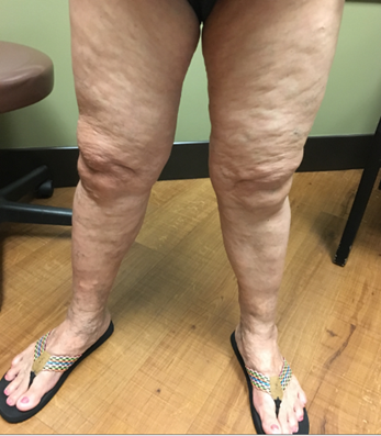 Vein Surgery Patient - Before and After, Atlanta Vein Specialists