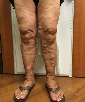 Vein Surgery Patient - Before and After, Atlanta Vein Specialists