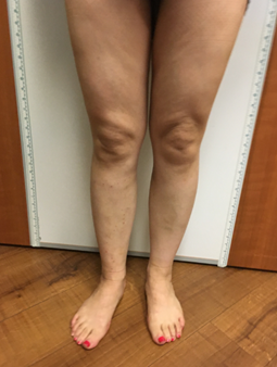 Vein Surgery Patient - Before and After, Atlanta Vein Specialists