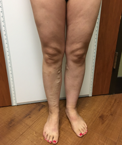 Vein Surgery Patient - Before and After, Atlanta Vein Specialists