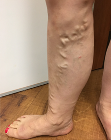 Vein Surgery Patient - Before and After, Atlanta Vein Specialists