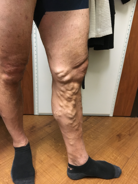 Vein Surgery Patient - Before and After, Atlanta Vein Specialists