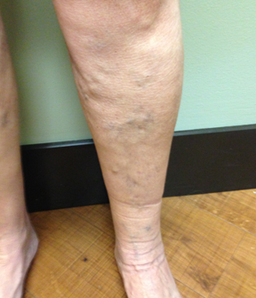 Vein Surgery Patient - Before and After, Atlanta Vein Specialists