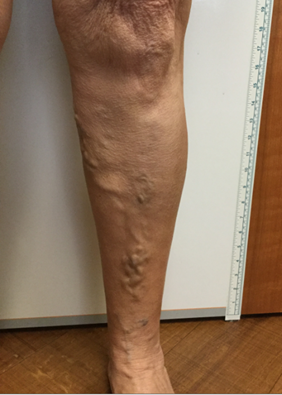 Vein Surgery Patient - Before and After, Atlanta Vein Specialists