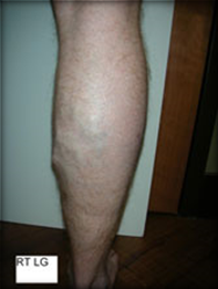 Vein Surgery Patient - Before and After, Atlanta Vein Specialists