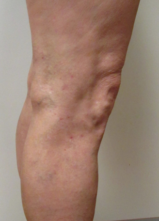 Vein Surgery Patient - Before and After, Atlanta Vein Specialists