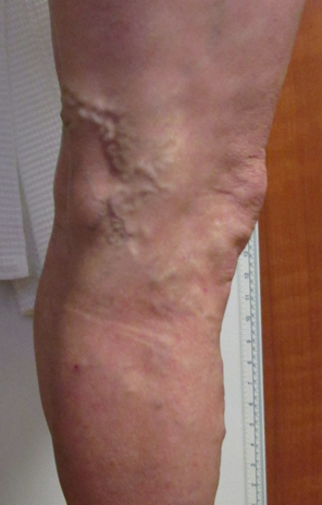 Vein Surgery Patient - Before and After, Atlanta Vein Specialists