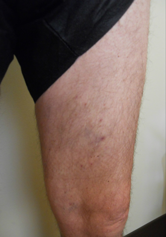 Vein Surgery Patient - Before and After, Atlanta Vein Specialists