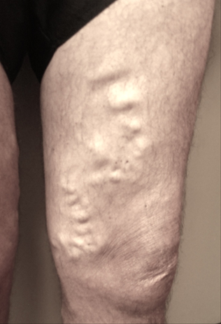 Vein Surgery Patient - Before and After, Atlanta Vein Specialists