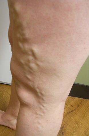 Vein Surgery Patient - Before and After, Atlanta Vein Specialists