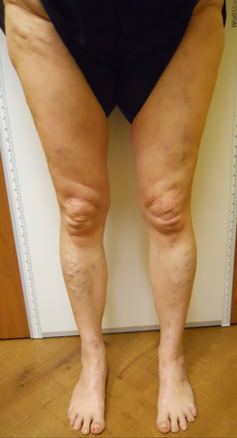 Vein Surgery Patient - Before and After, Atlanta Vein Specialists