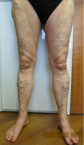 Vein Surgery Patient - Before and After, Atlanta Vein Specialists