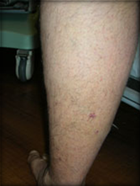 Vein Surgery Patient - Before and After, Atlanta Vein Specialists