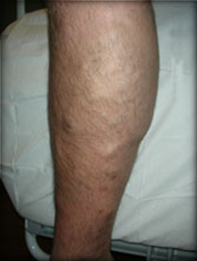 Vein Surgery Patient - Before and After, Atlanta Vein Specialists