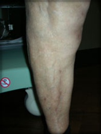 Vein Surgery Patient - Before and After, Atlanta Vein Specialists