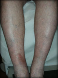 Vein Surgery Patient - Before and After, Atlanta Vein Specialists