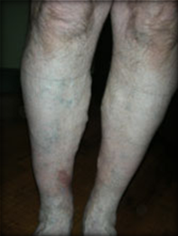 Vein Surgery Patient - Before and After, Atlanta Vein Specialists