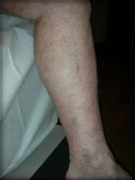 Vein Surgery Patient - Before and After, Atlanta Vein Specialists