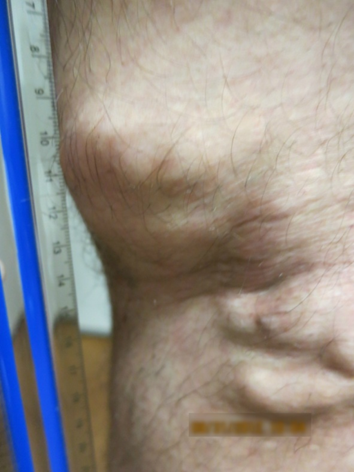 Vein Surgery Patient - Before and After, Atlanta Vein Specialists