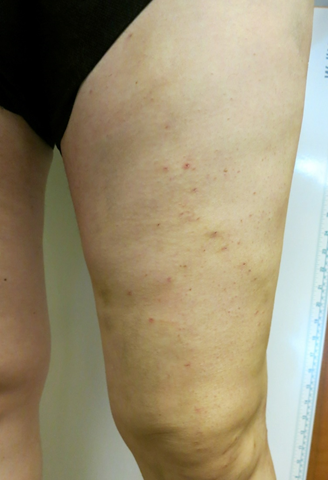 Vein Surgery Patient - Before and After, Atlanta Vein Specialists