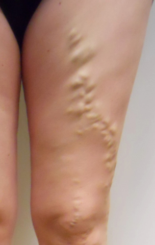 Vein Surgery Patient - Before and After, Atlanta Vein Specialists