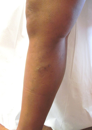 Vein Surgery Patient - Before and After, Atlanta Vein Specialists