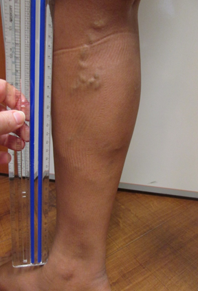 Vein Surgery Patient - Before and After, Atlanta Vein Specialists