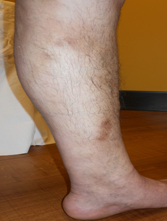 Vein Surgery Patient - Before and After, Atlanta Vein Specialists